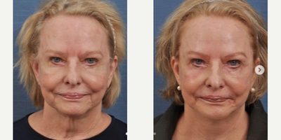 Facelift before and after photo