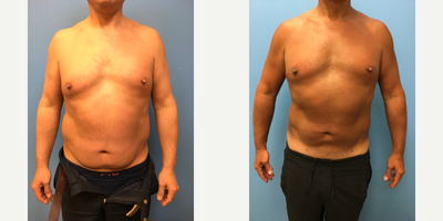 Liposuction before and after photo