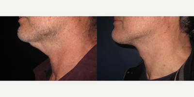 Neck Lift before and after photo