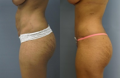 Panniculectomy before and after photo