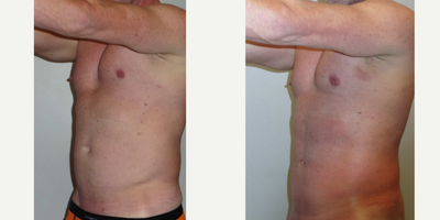Vaser Liposuction before and after photo