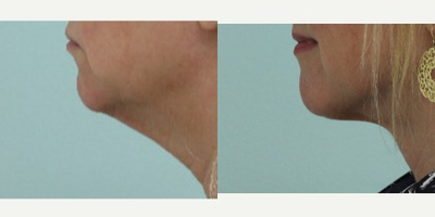 Chin Liposuction before and after photo