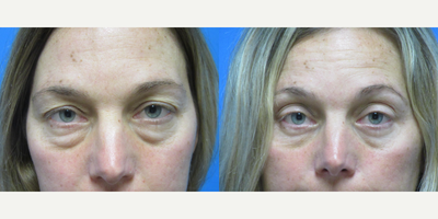 Eyelid Surgery before and after photo