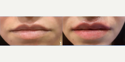Lip Fillers before and after photo