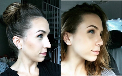 Rhinoplasty before and after photo