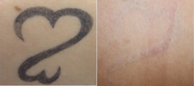 Tattoo Removal before and after photo