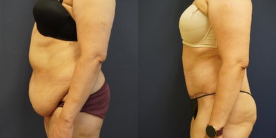 Tummy Tuck before and after photo
