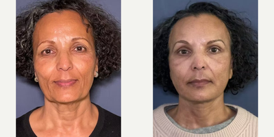 Eyelid Surgery before and after photo