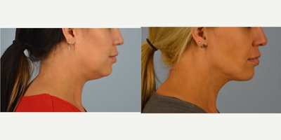 FaceTite before and after photo