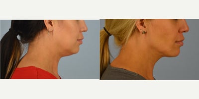 FaceTite before and after photo