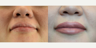 Juvederm before and after photo