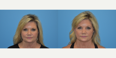 Lower Facelift before and after photo