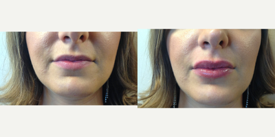 Restylane before and after photo