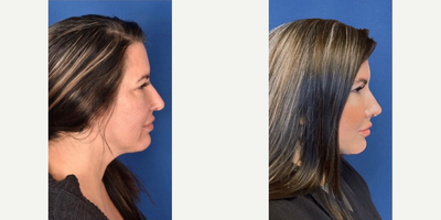 Rhinoplasty before and after photo
