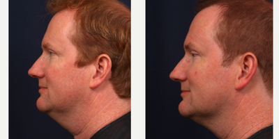 Ultherapy before and after photo