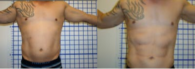 Vaser Liposuction before and after photo