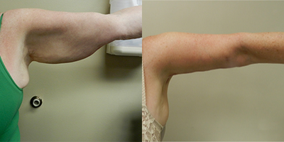 Arm Lift before and after photo