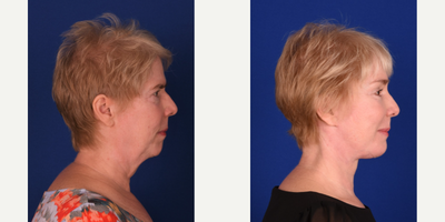Brow Lift before and after photo