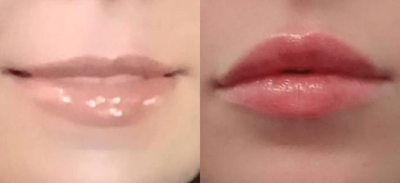 Dermal Fillers before and after photo