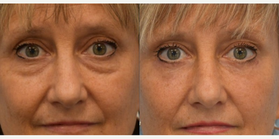 Eyelid Surgery before and after photo