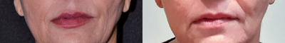 Juvederm before and after photo