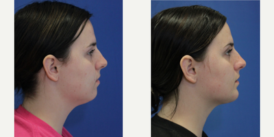 Liposuction before and after photo
