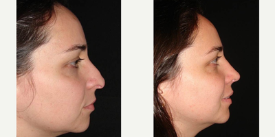 Revision Rhinoplasty before and after photo