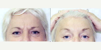 Brow Lift before and after photo