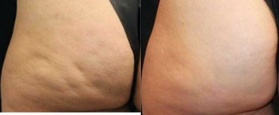 Cellfina before and after photo