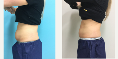 CoolSculpting before and after photo