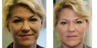 Dysport before and after photo