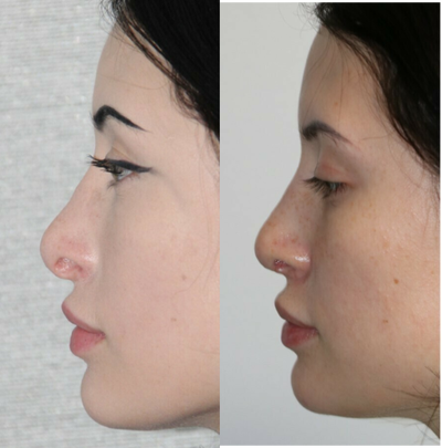 Revision Rhinoplasty before and after photo