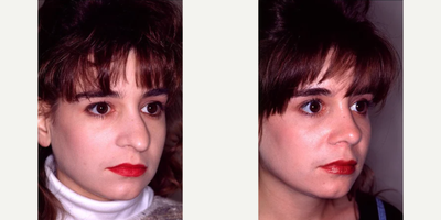 Septoplasty before and after photo