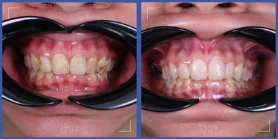 Dental Bonding before and after photo