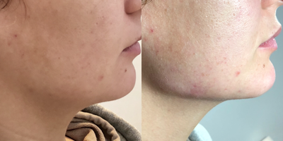 Dermal Fillers before and after photo