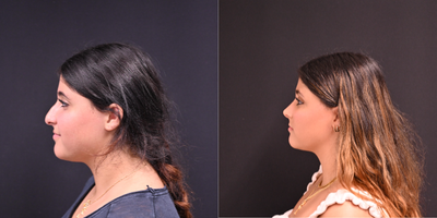 Rhinoplasty before and after photo