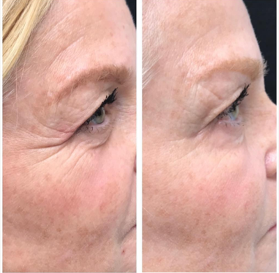 Xeomin before and after photo