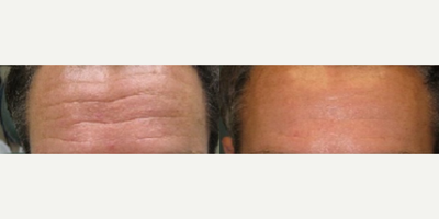 Botox before and after photo