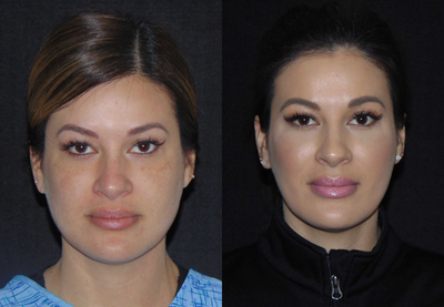 Facial Fat Transfer before and after photo
