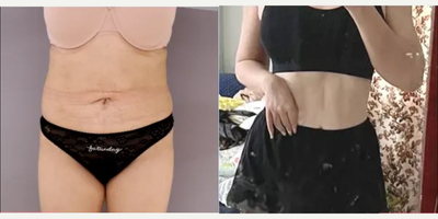 Liposuction before and after photo