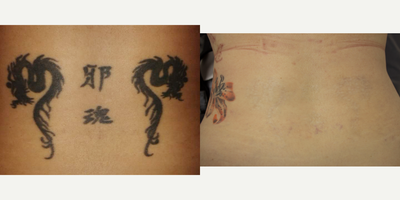 Tattoo Removal before and after photo