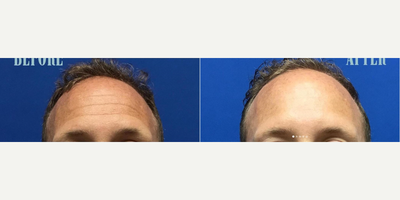Botox before and after photo