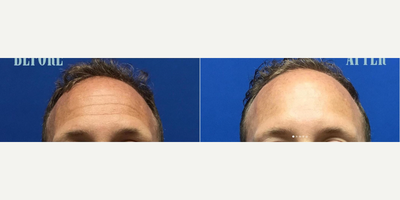 Botox before and after photo