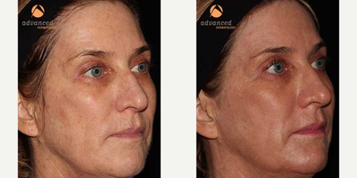 CO2 Laser before and after photo