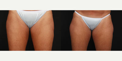 CoolSculpting before and after photo