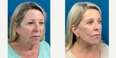 Neck Lift before and after photo