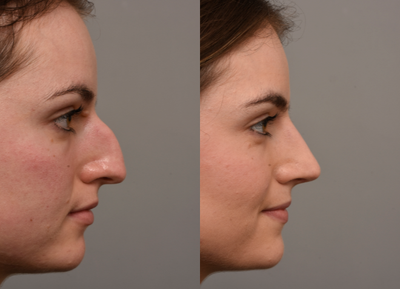 Rhinoplasty before and after photo