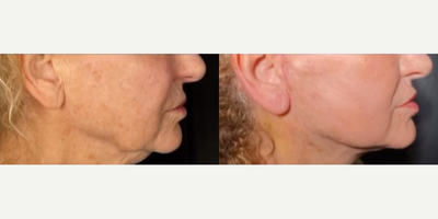 Vaser Liposuction before and after photo