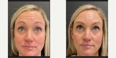 Botox before and after photo