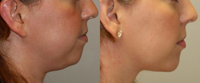 Buccal Fat Removal before and after photo